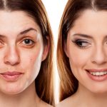 Things You Should Know About Dermal Fillers