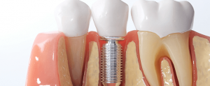 How To Select The Appropriate Dentist For Your Surgery?